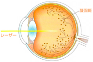 レーザー治療