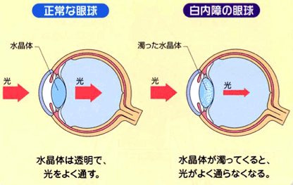 白内障